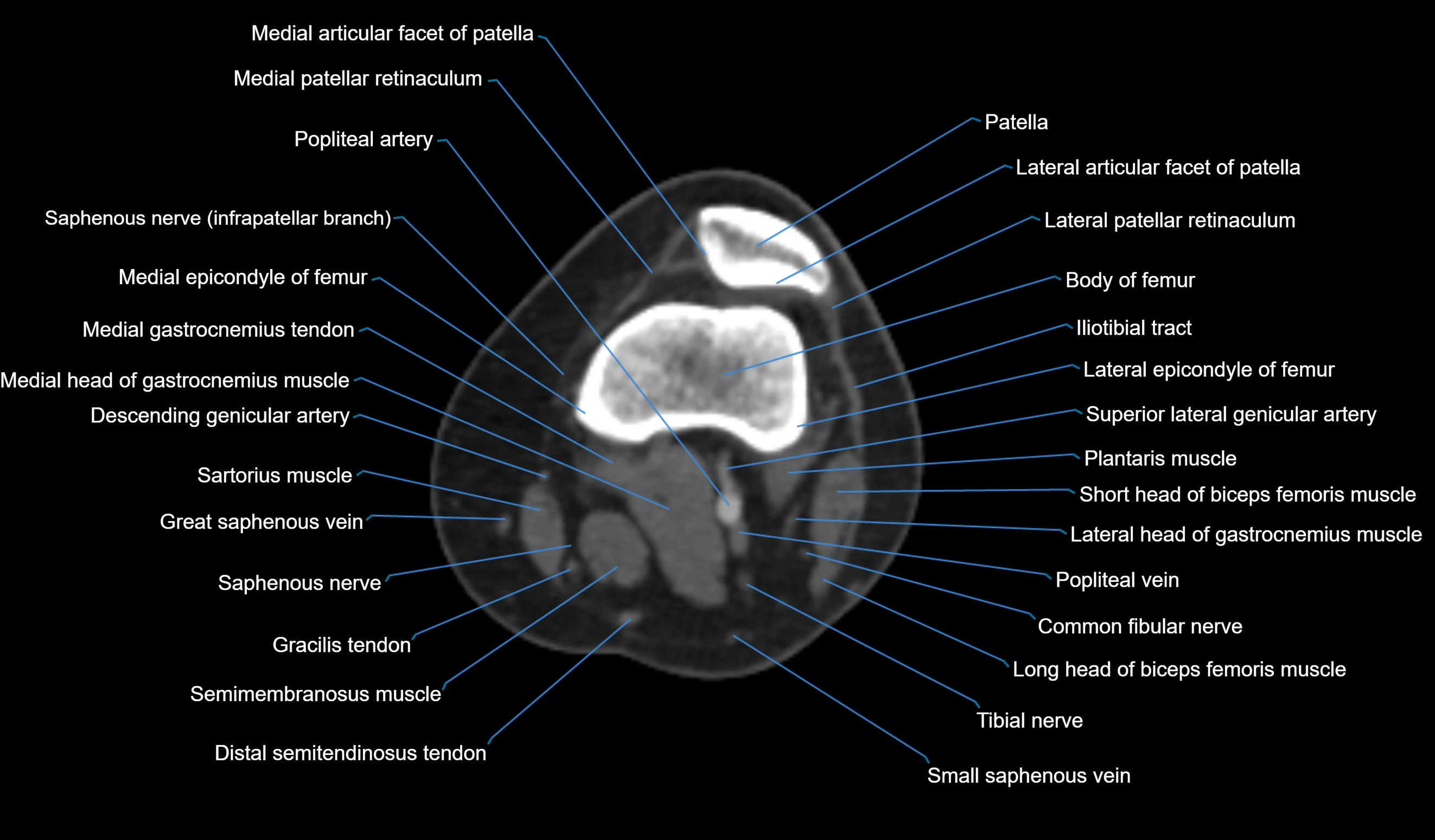 CT knee axial cross sectional anatomy labelled image-00022.webp